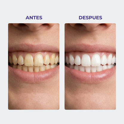 🧠Dientes más blancos en 7 días  🧠